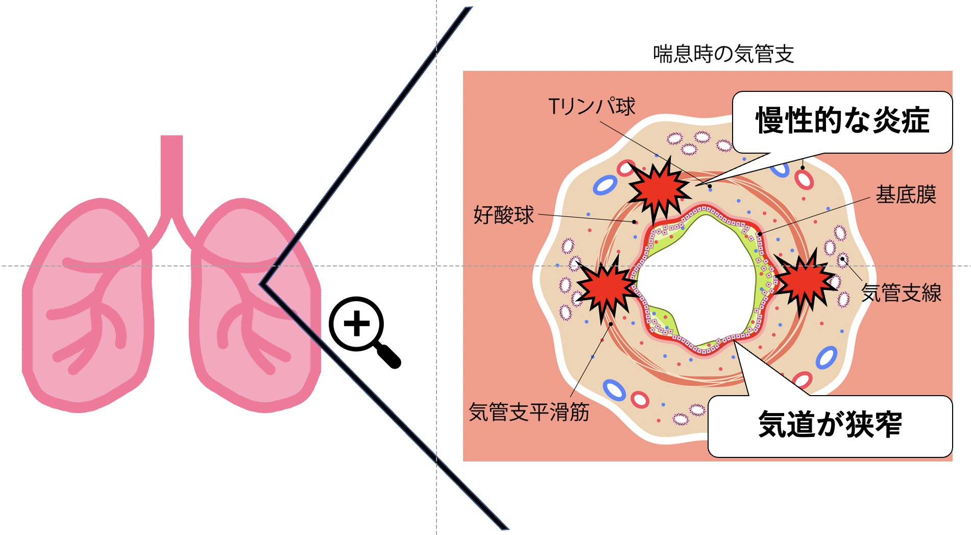 喘息時の気管支