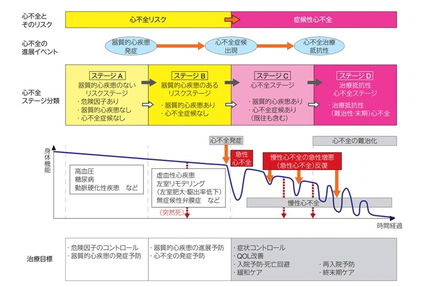 心不全のステージと治療