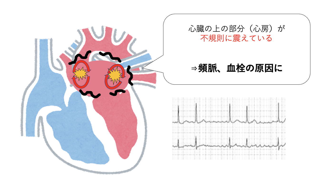 心房細動